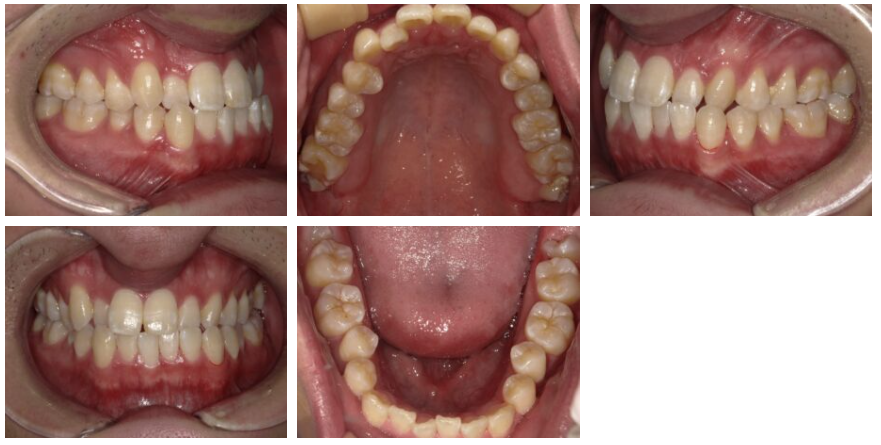 インビザライン矯正症例紹介 治療前写真