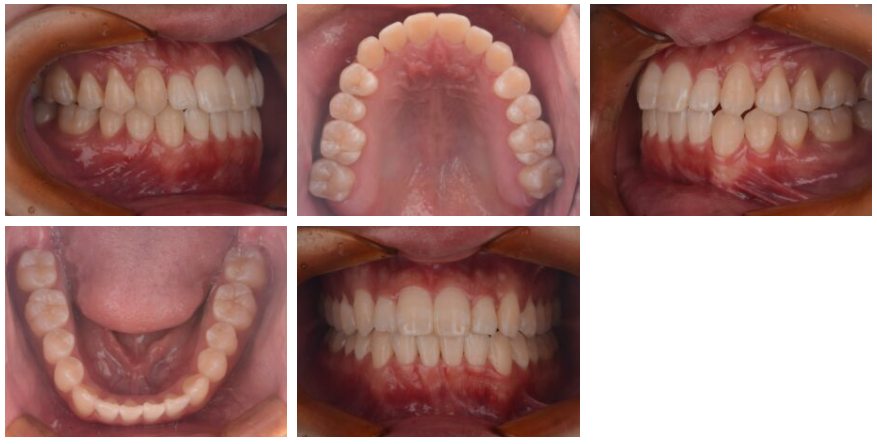 インビザライン矯正症例紹介 治療後写真