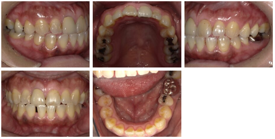 インビザライン矯正症例紹介 治療前写真
