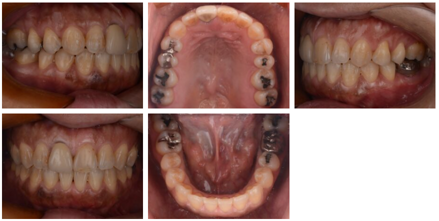 インビザライン矯正症例紹介 治療後写真